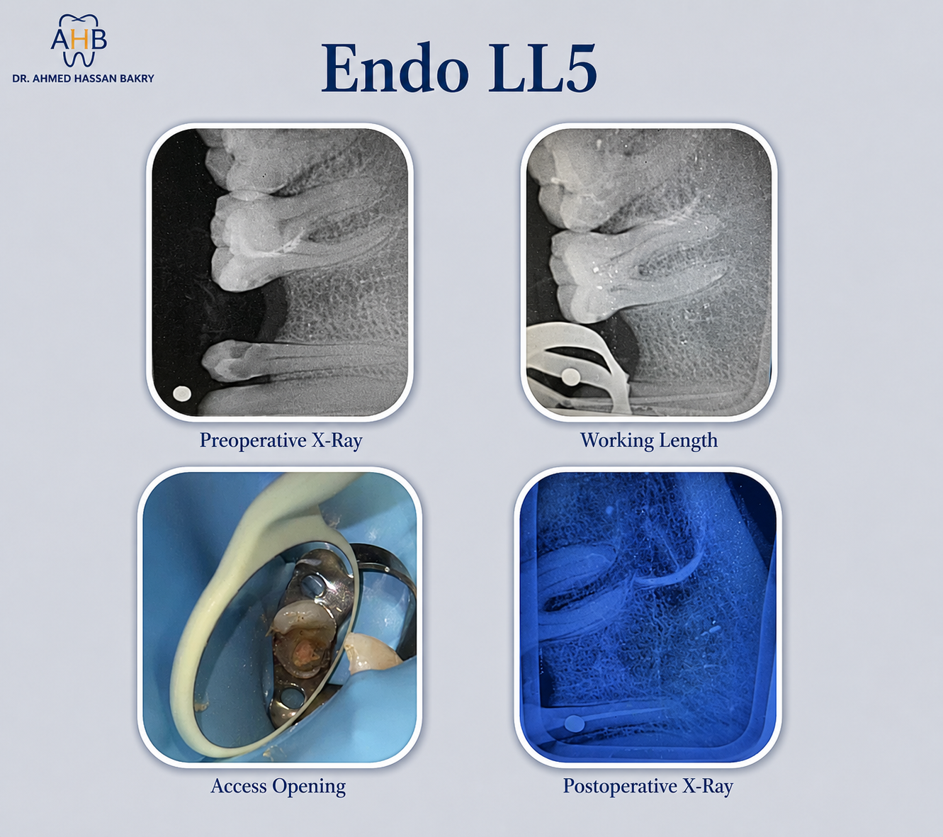 Endo LL5